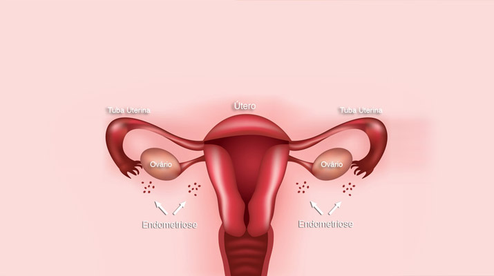 Causas Endometriose